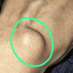 Ganglion, withered skin, weight loss and Homeopathy
