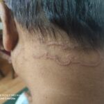Cutaneous larva migrans