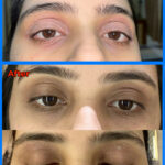 Atopic Dermatitis of the Eyelids (Eczema)